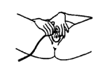 Holding the lips open or the foreskin back, gently put the catheter into the urine hole.