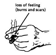 Loss of feeling (burns and scars)