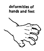 Deformities of hands and feet.