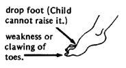 Slight weakness or deformity in the feet.