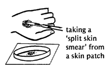 Taking a 'split skin smear' from a skin patch.