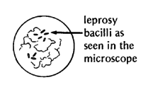 Leprosy bacilli as seen in the microscope.