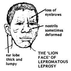 THE 'LION FACE' OF LEPROMATOUS LEPROSY.