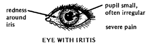 EYE WITH IRITIS