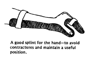 A good splint for the hand.