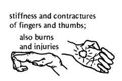 Stiffness and contractures of fingers and thumbs.