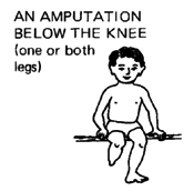 An Amputation below the knee