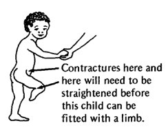Contractures will need to be straightened before this child can be fitted with a limb.