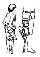 Walking aids or artificial limbs may be useful until the child can get a limb that keeps the joint straight.