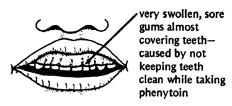 Swelling and abnormal growth of the gums.
