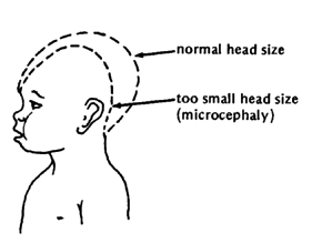 A child with microcephaly.