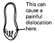 This can cause a painful dislocation.