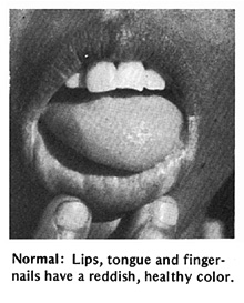 Normal - Lips, tongue and finger-nails have a reddish, healthy color.