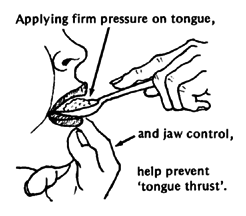 Applying firm pressure on tongue.