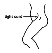 The thigh is pulled forward by tight cords.