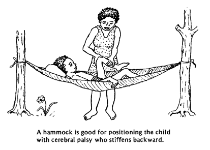 A hammock is good for positioning the child with cerebral palsy who stiffens backward.