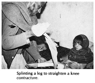 Splinting a leg to straighten a knee contracture.