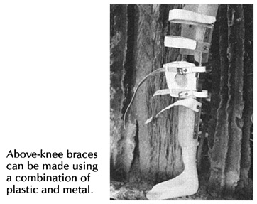 Above-knee braces can be made using a combination of plastic and metal.