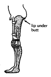 Lip under butt