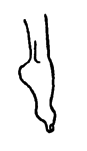 A child with 'footdrop' or a floppy foot that hangs down.