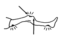 Pressure sores on the small areas where the splint presses,