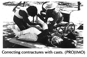 Correcting contractures with casts.