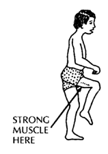 An older child who has a knee contracture with strong muscles that bend the knee.