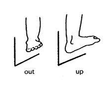 Overcorrected foot (out & up)