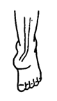 The heel still bends in even after the bend of the foot has been corrected.