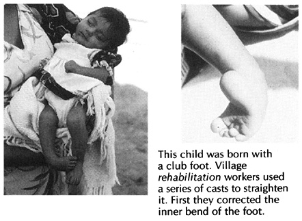 A baby who was born with a club foot.