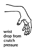 Wrist drop from crutch pressure.