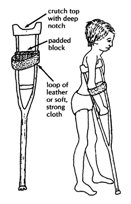 Crutch for a child with weak elbow-straightening muscles.
