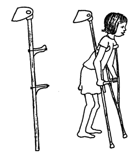Hoe adapted as crutch.