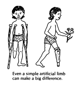 Even a simple artificial limb can make a big difference.