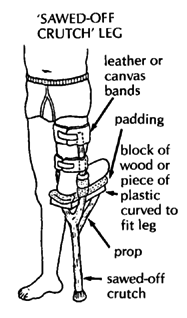 With the knee bent ('Sawed-off crutch' leg)