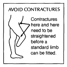 AVOID CONTRACTURES.