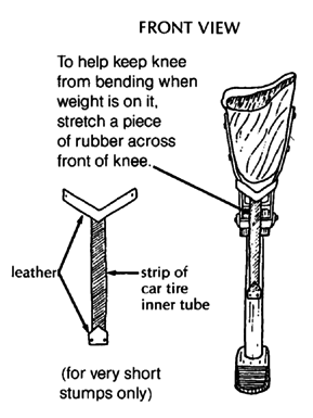 Above-knee limb's front view.