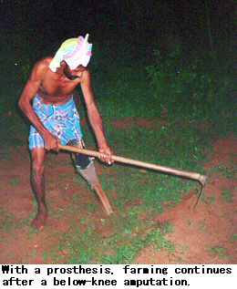 With a prosthesis, farming continues after a below-knee amputation.