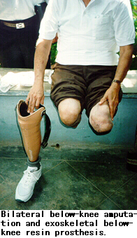 Bilateral below-knee amputation and exoskeletal below-knee resin prosthesis.