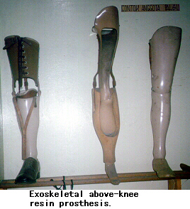 Exoskeletal above-knee resin prosthesis.