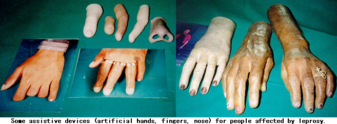 Some assistive devices (artificial hands, fingers, nose) for people affected by leprosy.