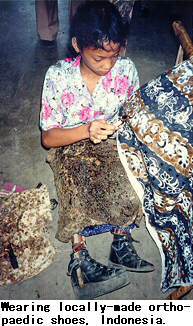 Wearing locally-made orthopaedic shoes, Indonesia.