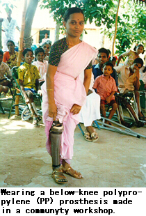 Wearing a below-knee polypropylene (PP) prosthesis made in a community workshop.