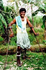 A man wearing the braces on both legs is standing with his crutches.