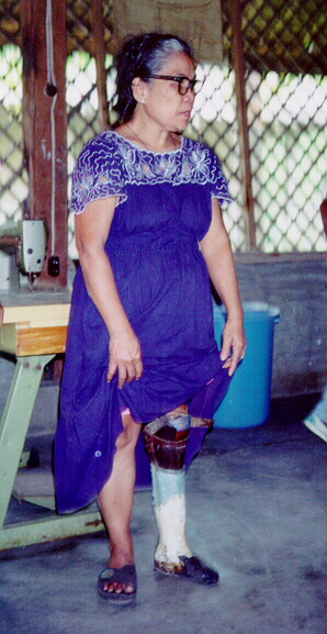 A women is standing with a lower-limb prostheses on her left leg.