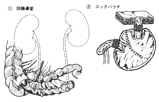 図１　代用膀胱