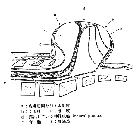 図３　脊髄髄膜瘤の縦断図