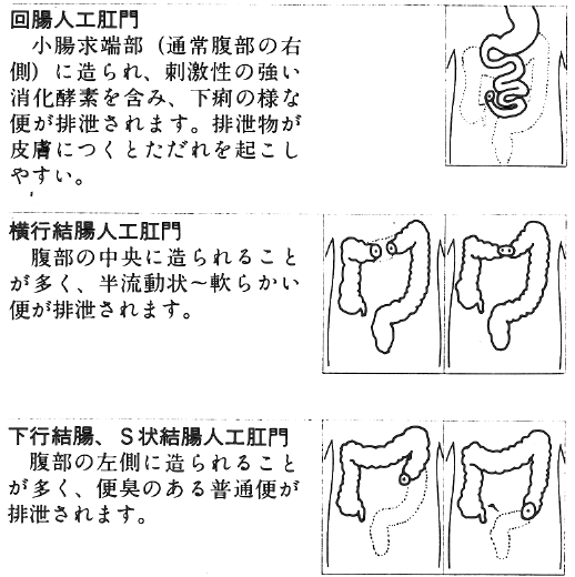 図４　人工肛門の位置と名称