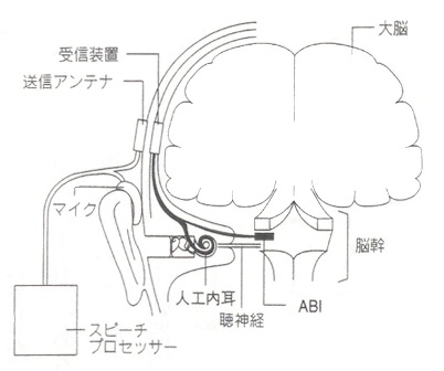 図３　人工内耳とＡＢＩ