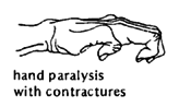 Hand paralysis with contractures.
